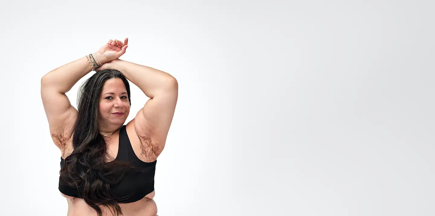 To the left of the image, a woman with brown hair poses looking into the camera while raising her arms showing scars from her hidradenitis suppurativa (HS) flares in her armpits. To her right reads a headline: "HS TRUTHS: It's not your hygiene. It's not caused by your weight. It's not your fault" Below is a tag with the patient's name which reads "Tatiana, real HS patient."
