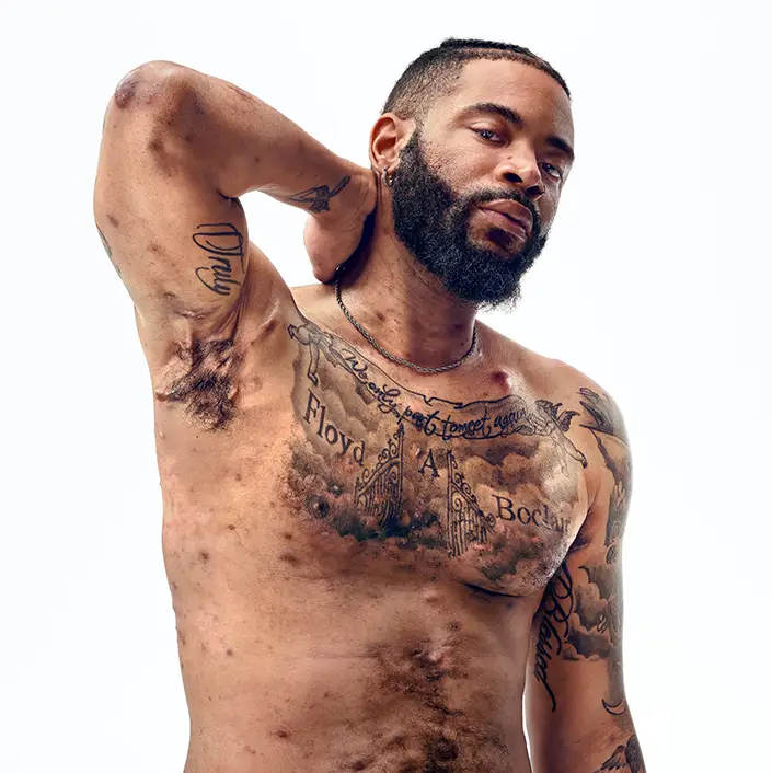 A Black man with a beard, and hidradenitis suppurativa (HS), poses facing the camera with his tattooed chest exposed, with his arm up to show scars from his HS flares. Below the photo is a tag with the patient's name which reads "Jawan, real HS patient." 