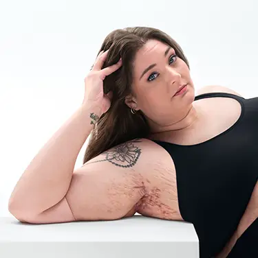 To the right of the image a White woman who has brown hair poses looking into the camera leaning on her arm and showing her armpit with HS scars from her hidradenitis suppurativa (HS) flares. Below the image is a tag with the patient's name which reads "Katelyn, real HS patient."  