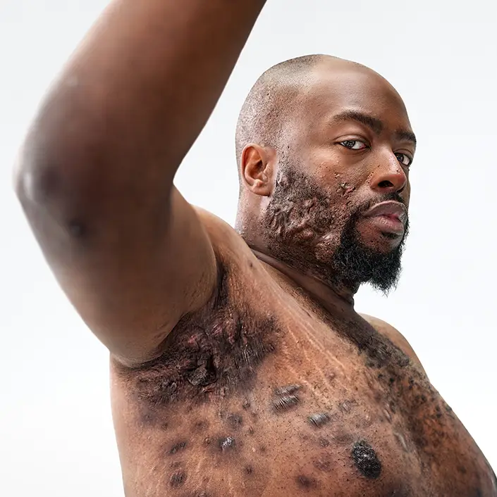 A Black man, with hidradenitis suppurativa (HS), poses looking into the camera with his right arm up, showing scars from his HS flares. Below the photo is a tag with the patients name which reads "Parish, real HS patient." 