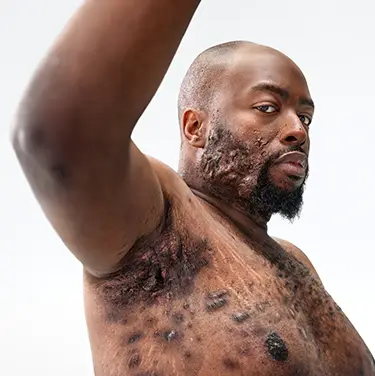 A Black man, with hidradenitis suppurativa (HS), poses looking into the camera with his right arm up, showing scars from his HS flares. Below the photo is a tag with the patients name which reads "Parish, real HS patient." 