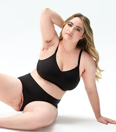 To the left of the image, a White woman with blonde hair poses looking into the camera while her armpit and groin are exposed, showing scars from her hidradenitis suppurativa (HS) flares. To her right reads a headline: "HS TRUTH: HS runs deep. It's driven by inflammation beneath your skin" Below the headline is a tag with the patient's name which reads "Ashley, real HS patient."