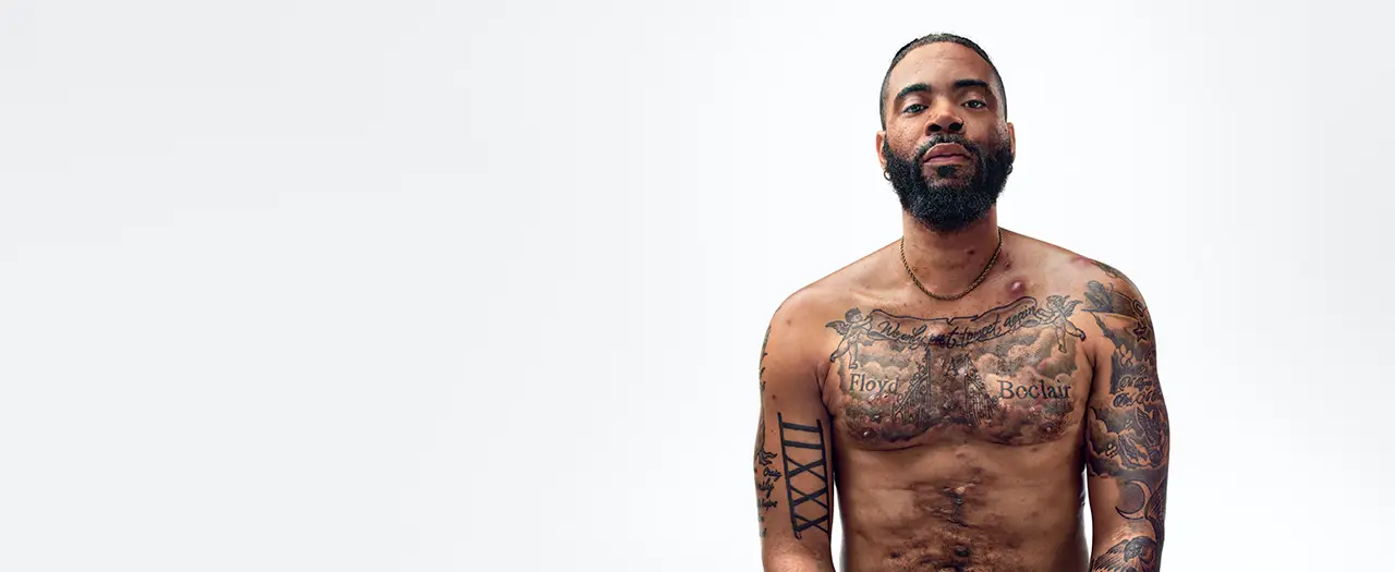A Black man with a beard, and hidradenitis suppurativa (HS), poses facing the camera with his tattooed chest exposed, with his arm up to show scars from his HS flares. Below the photo is a tag with the patient's name which reads "Jawan, real HS patient." 