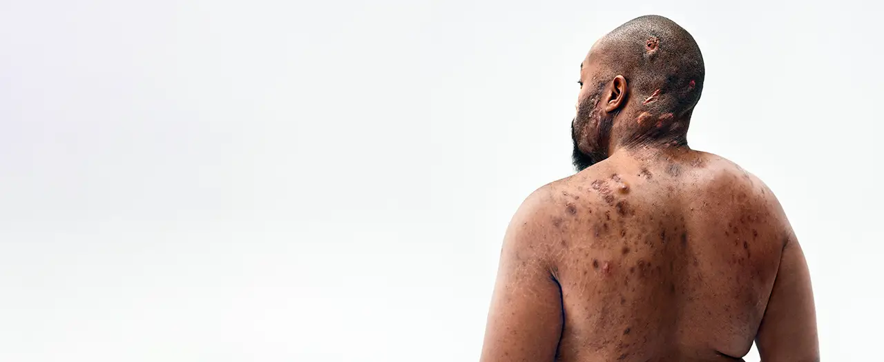 A Black man, with hidradenitis suppurativa (HS), poses with his back to the camera. On his back his HS scars are visible Below is a tag which reads "Parish, real HS patient."