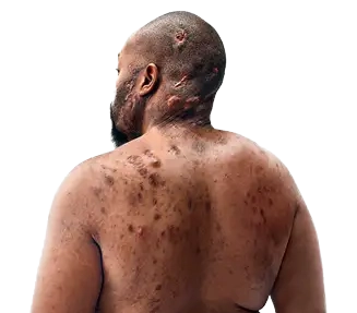 A Black man, with hidradenitis suppurativa (HS), poses with his back to the camera. On his back his HS scars are visible Below is a tag which reads "Parish, real HS patient."