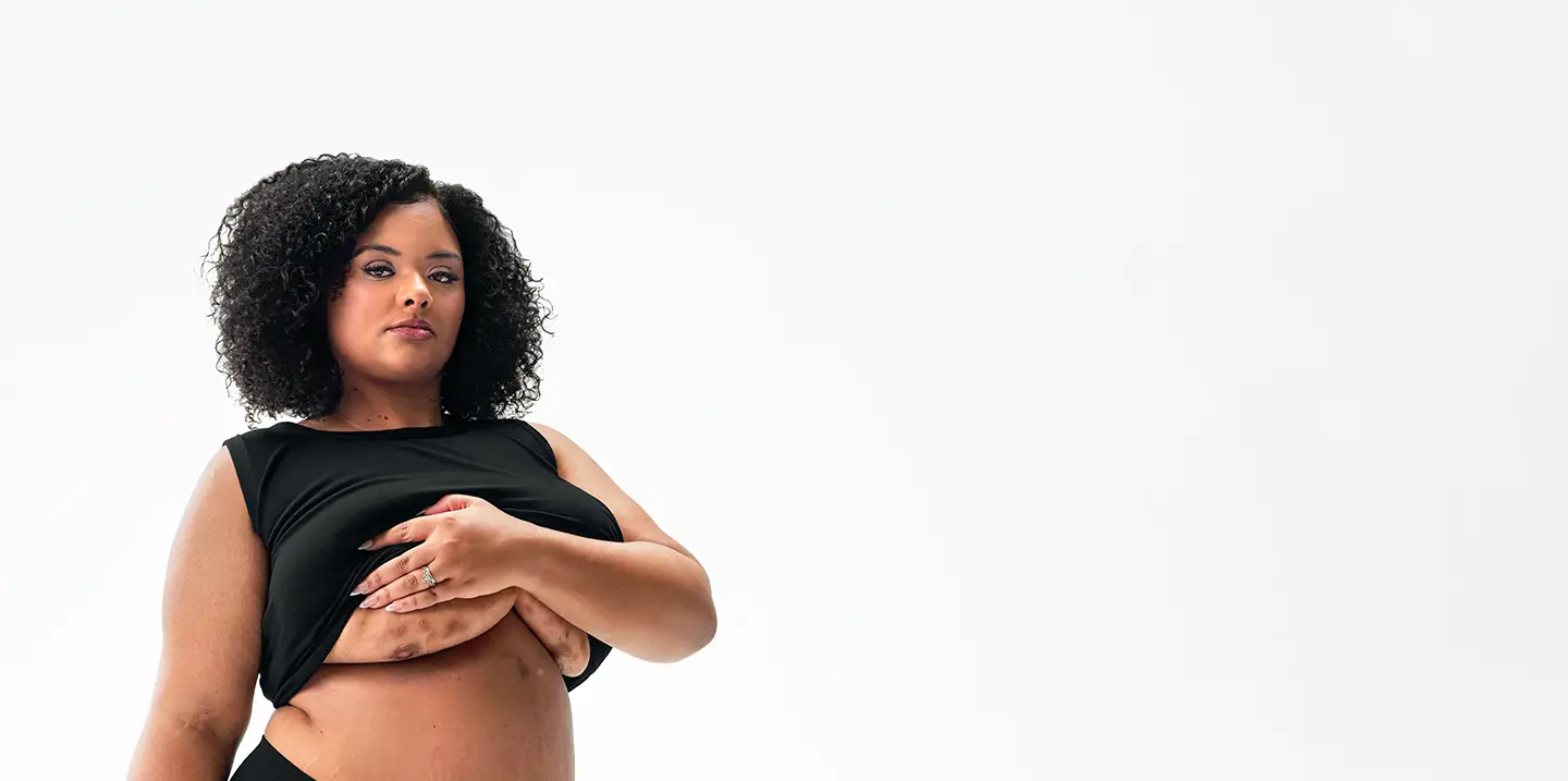 To the left of the image, a Black woman poses looking into the camera while lifting up her shirt, showing scars from her hidradenitis suppurativa (HS) flares under her right and left breasts. To her right reads a headline: "HS TRUTH: Your voice matters, and your care depends on it" Below the headline is a tag with the patient's name which reads "Jasmine S, real HS patient."