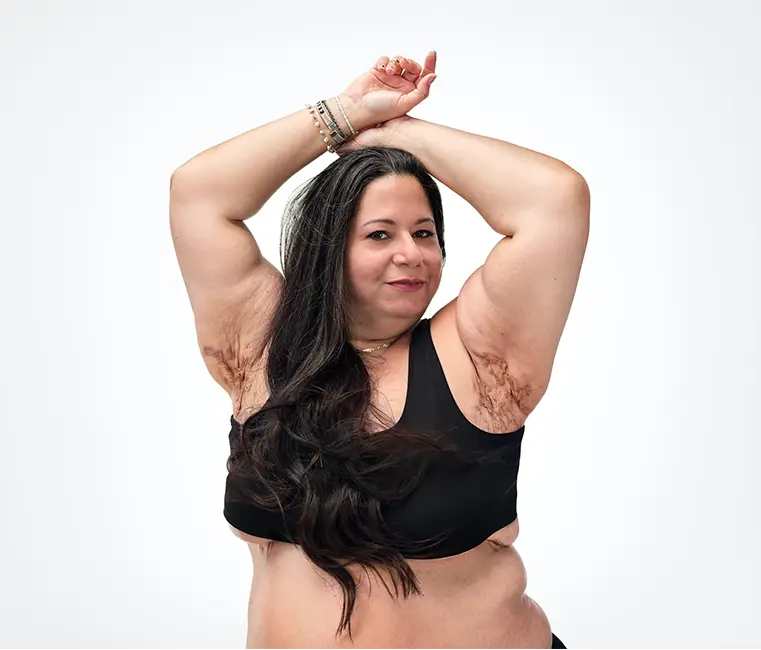 A woman with long brown hair poses with an empowered expression on her face in a bra and underwear with her arms raised showing her HS scars under her armpits. Below the headline is a tag with the patient's name which reads "Tatiana, real HS patient."