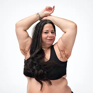 A woman with long brown hair poses with an empowered expression on her face in a bra and underwear with her arms raised showing her HS scars under her armpits. Below the headline is a tag with the patient's name which reads "Tatiana, real HS patient."