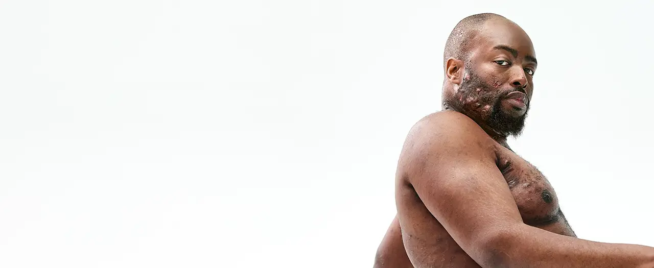 A Black man, with hidradenitis suppurativa (HS), poses with a look of defiance into the camera without his shirt on. Below is a tag which reads "Parish, real HS patient." 