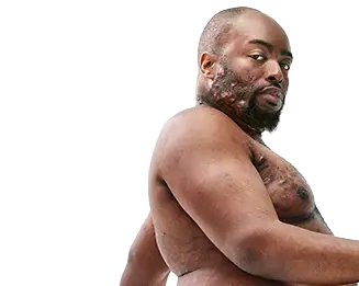 A Black man, with hidradenitis suppurativa (HS), poses with a look of defiance into the camera without his shirt on. Below is a tag which reads "Parish, real HS patient." 