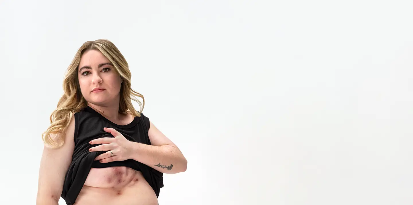 To the left of the image, a White woman with blonde hair poses looking into the camera lifting up her shirt, showing scars from her hidradenitis suppurativa (HS) flares under her right breast. To her right reads a headline: "HS TRUTH: What HS does to your body is only half the story" Below the headline is a tag with the patient's name which reads "Ashley, real HS patient."