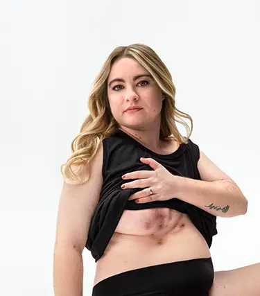 To the left of the image, a White woman with blonde hair poses looking into the camera lifting up her shirt, showing scars from her hidradenitis suppurativa (HS) flares under her right breast. To her right reads a headline: "HS TRUTH: What HS does to your body is only half the story" Below the headline is a tag with the patient's name which reads "Ashley, real HS patient."
