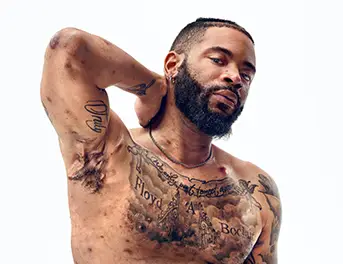 A Black man with a beard, and hidradenitis suppurativa (HS), poses facing the camera with his tattooed chest exposed, with his arm up to show scars from his HS flares. Below the photo is a tag with the patient's name which reads "Jawan, real HS patient." 
