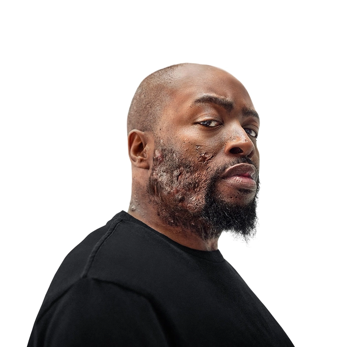 A Black man, with hidradenitis suppurativa (HS), poses with a look of defiance into the camera. Below is a tag which reads "Parish, real HS patient."