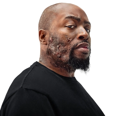 A Black man, with hidradenitis suppurativa (HS), poses with a look of defiance into the camera. Below is a tag which reads "Parish, real HS patient."