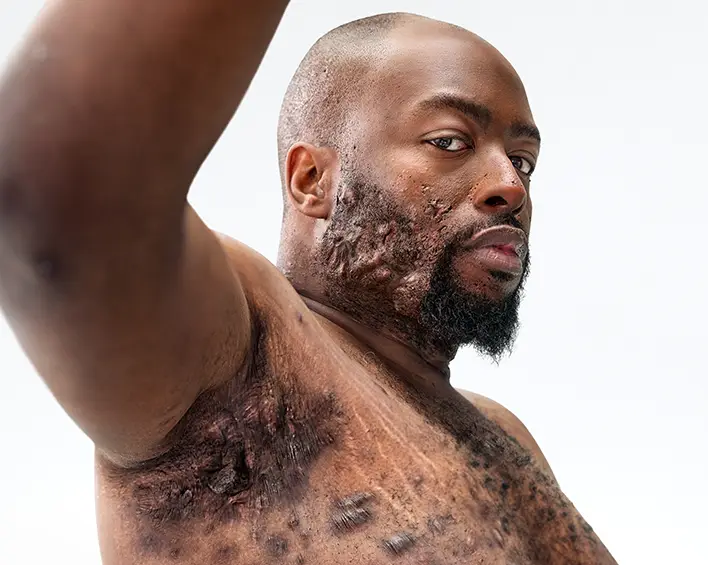 A Black man, with hidradenitis suppurativa (HS), poses looking into the camera with his right arm up, showing scars from his HS flares. Below the photo is a tag with the patients name which reads "Parish, real HS patient."