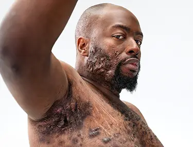 A Black man, with hidradenitis suppurativa (HS), poses looking into the camera with his right arm up, showing scars from his HS flares. Below the photo is a tag with the patients name which reads "Parish, real HS patient."