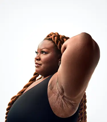 To the right of the image, a Black woman poses with long braids and a powerful expression with her face and her left arm up showing scars from her hidradenitis suppurativa (HS) flares. To her right reads a headline: "HS TRUTH: You don't have to manage alone. Stay connected." Below the headline is a tag with the patient's name which reads "Jasmine E, real HS patient."  